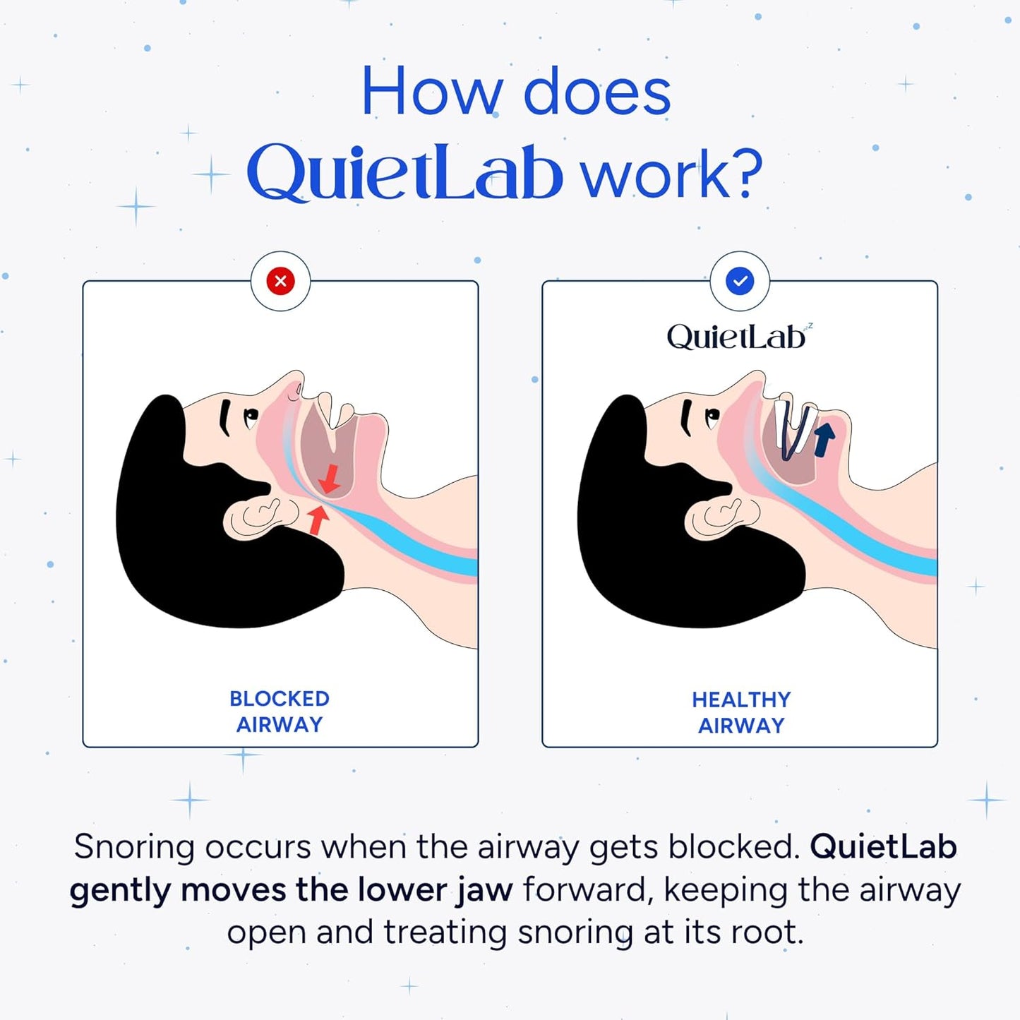 QuietLab Pro Anti-Snoring Mouthpiece - Adjustable Snoring Mouth Guard, Orthodontist Designed, No Boiling Required - BPA-Free Medical Grade - Designed for Nighttime Snoring Control